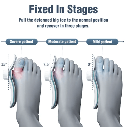 Orthopedic Toe Alignment Brace - Apex Therapy
